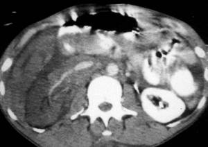 Traumatic injury rt renal pedicle